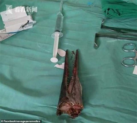 印尼少年随父母海钓 遭尖嘴针鱼跳出水扎穿脖子