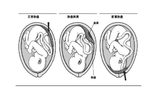 胎儿胎膜胎盘示意图图片