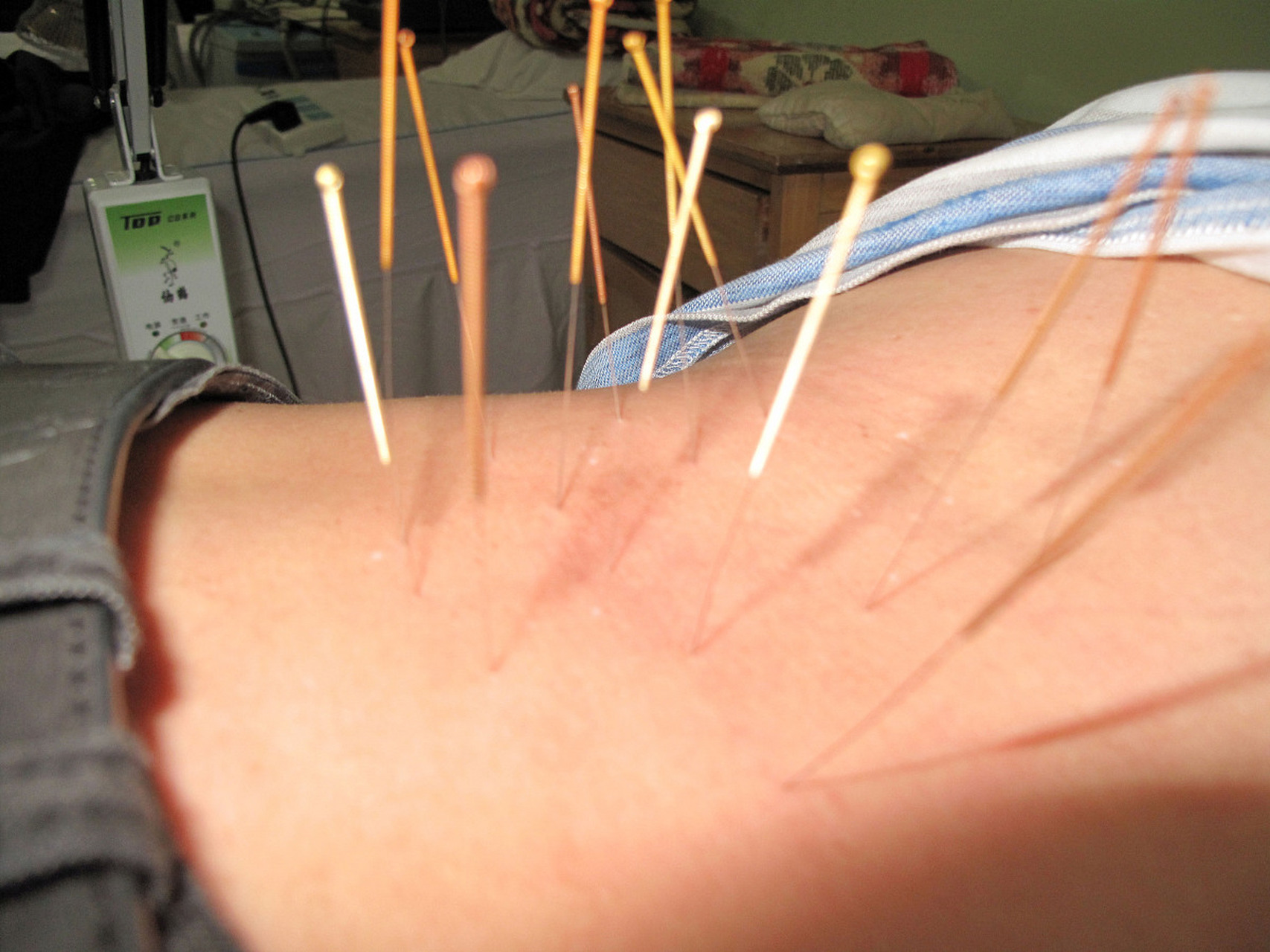 每天一个健康小知识# 腰疼扎针灸有用么?