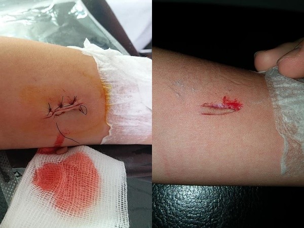 护士拔针失误剪到肉!呛男童「缝3针哭什么哭」母亲怒崩溃