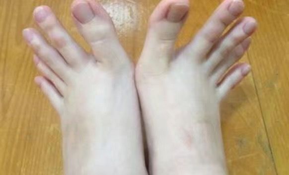 女子天生怪异的脚趾,最长的一根达到6厘米,找不到男朋友!