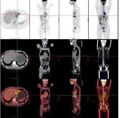 揭开「现代医学高科技之冠」PET/CT 的神秘面纱