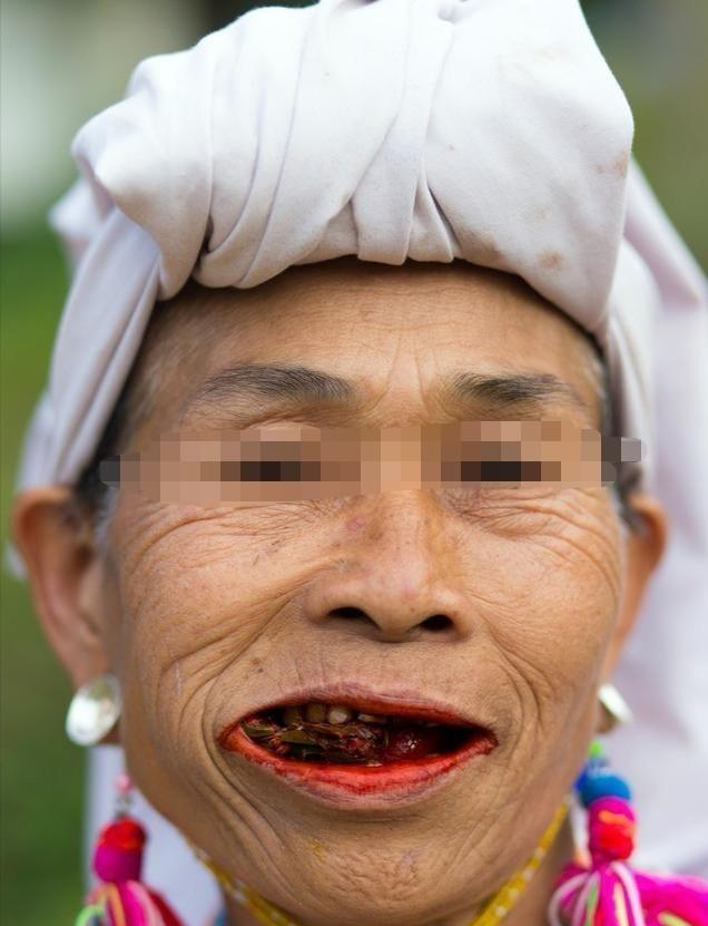 槟榔吃多了恐怖照片图片