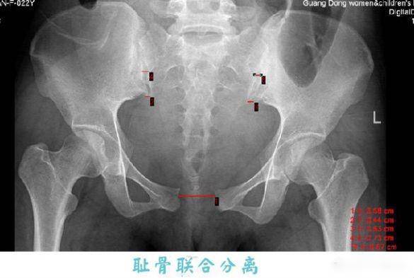 耻骨疼得早是不是生的比较快?有这三个特征的孕妇生孩子会比较快