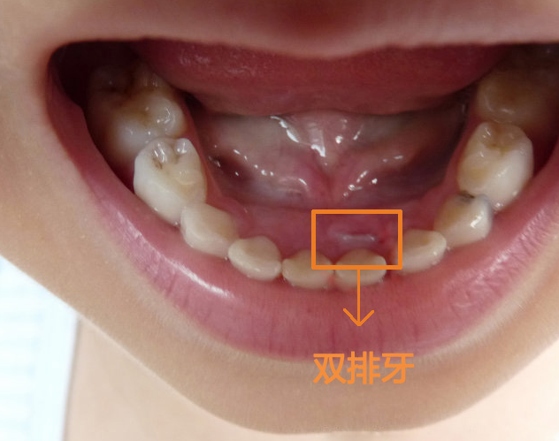 儿童换门牙正常图片图片