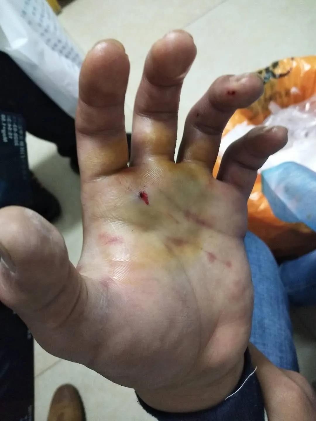 心疼!男孩左手卡进机器 手掌被压骨折