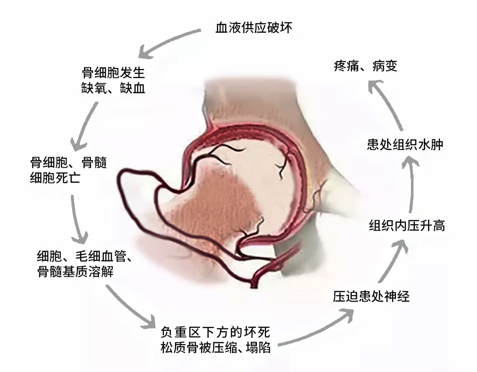 干细胞疗法对股骨头坏死的应用效果与评价