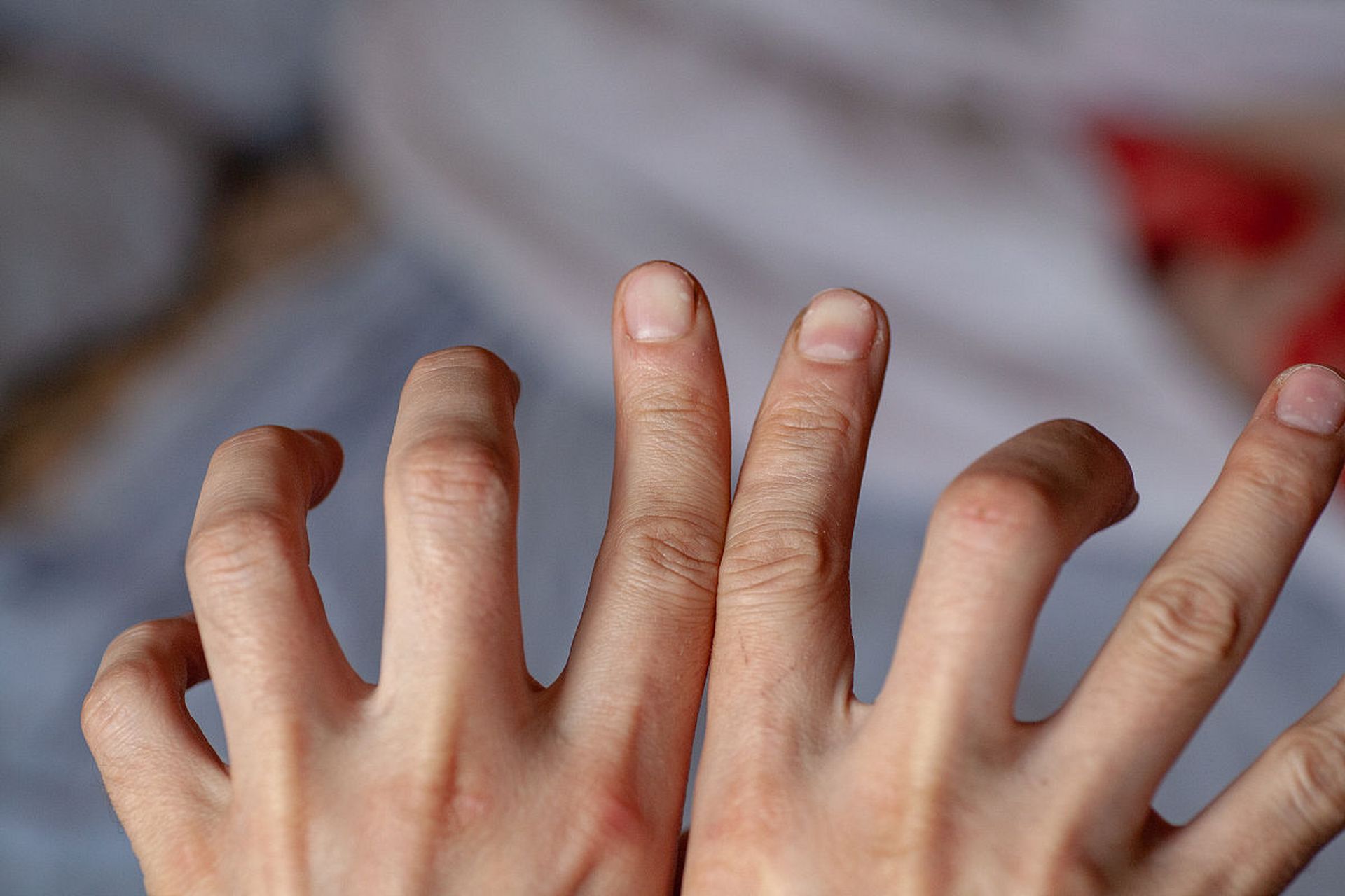 手指畸形病症:多指畸形的成因及治疗方法 手指畸形是指手指的形态或