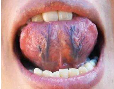 正常舌底图片图片