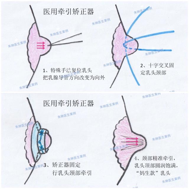 乳头内陷牵引术图片