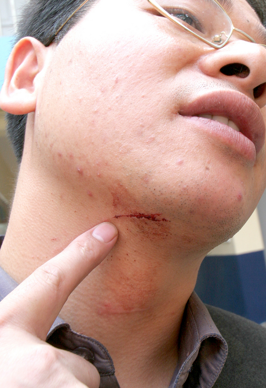 下巴长痘痘是原因和解决方法 #红蓝光祛痘#   下巴是我们面部的一个