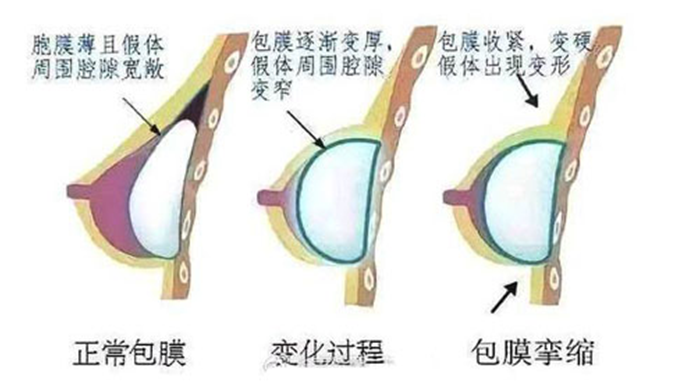 全面剖析假体丰胸包膜挛缩问题,安全丰胸才是关键