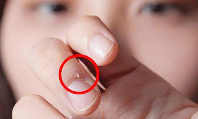 手指长「倒刺」,怎么无痛处理?