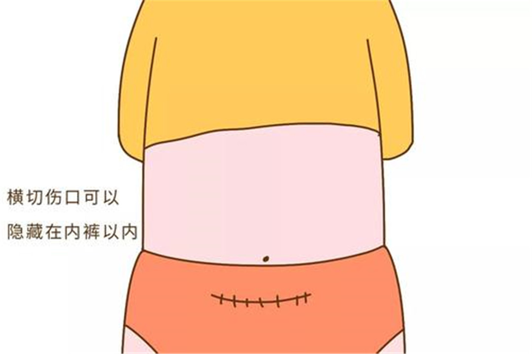 剖腹产的"横切"和"竖切"差别这么大,第一胎你可别选错了