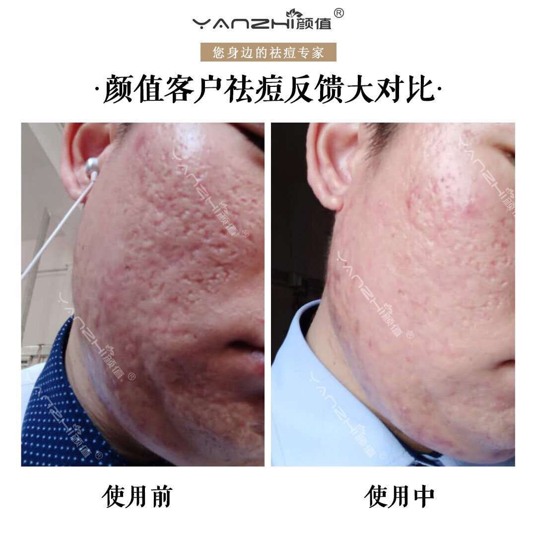 脸上很多痘坑怎样修复 可以化妆吗?