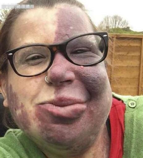 英国38岁女子天生"阴阳脸",尽管受尽嘲讽却坚持做自己