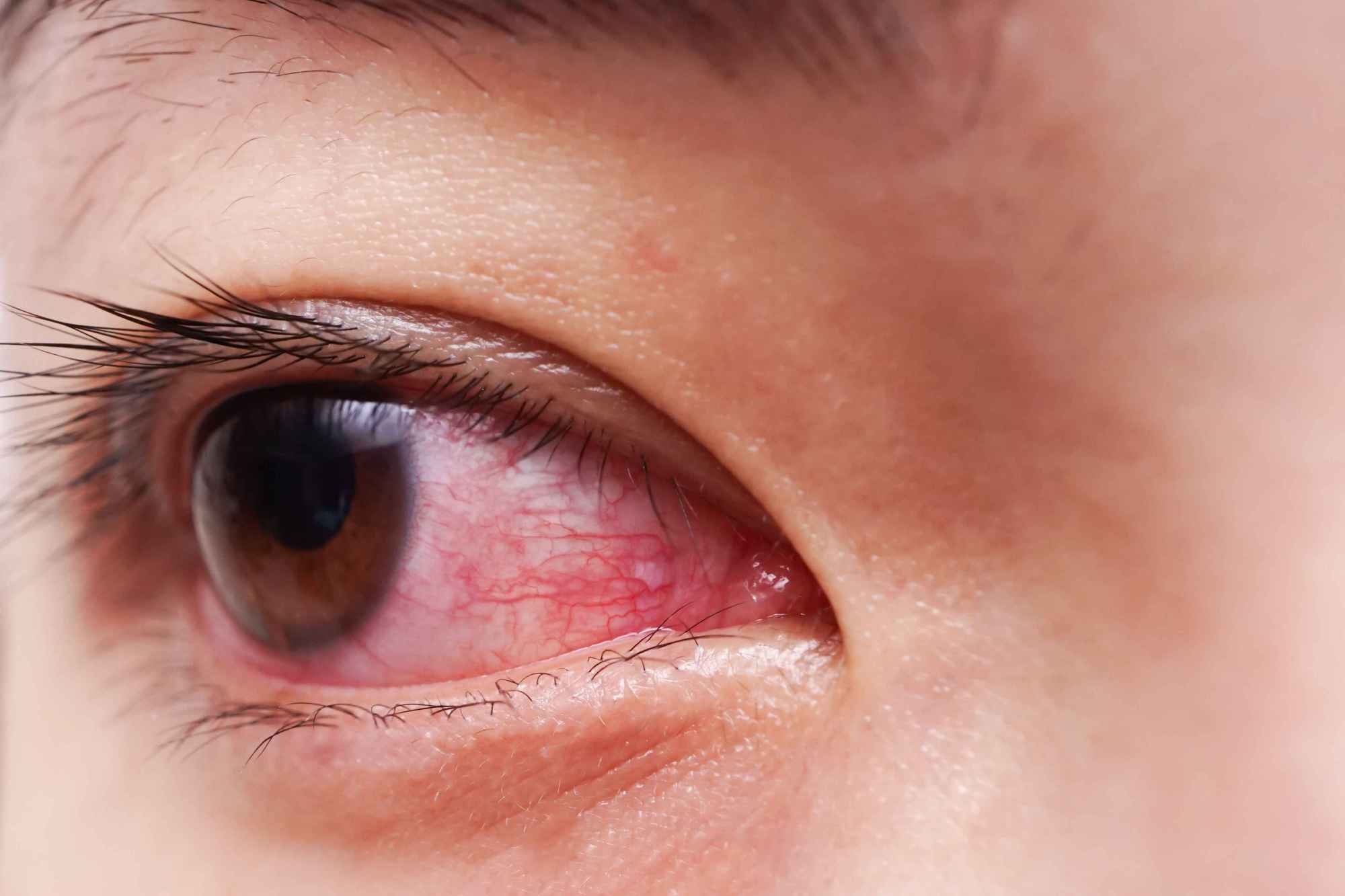 眼睛出现红血丝,是什么原因导致?5个小偏方帮你去除红血丝