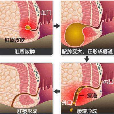 肛周脓肿是什么,怎么办?