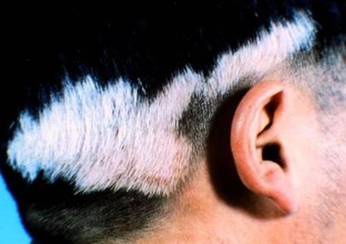 关于毛囊型白癜风,你都了解吗?该怎么预防?