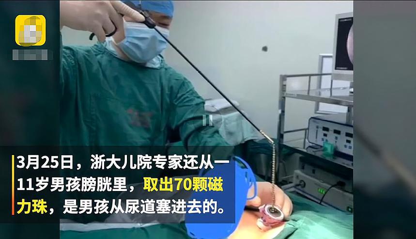 11岁男孩往尿道塞70颗磁力珠,小便时感觉痛楚后送医,家长:贪玩