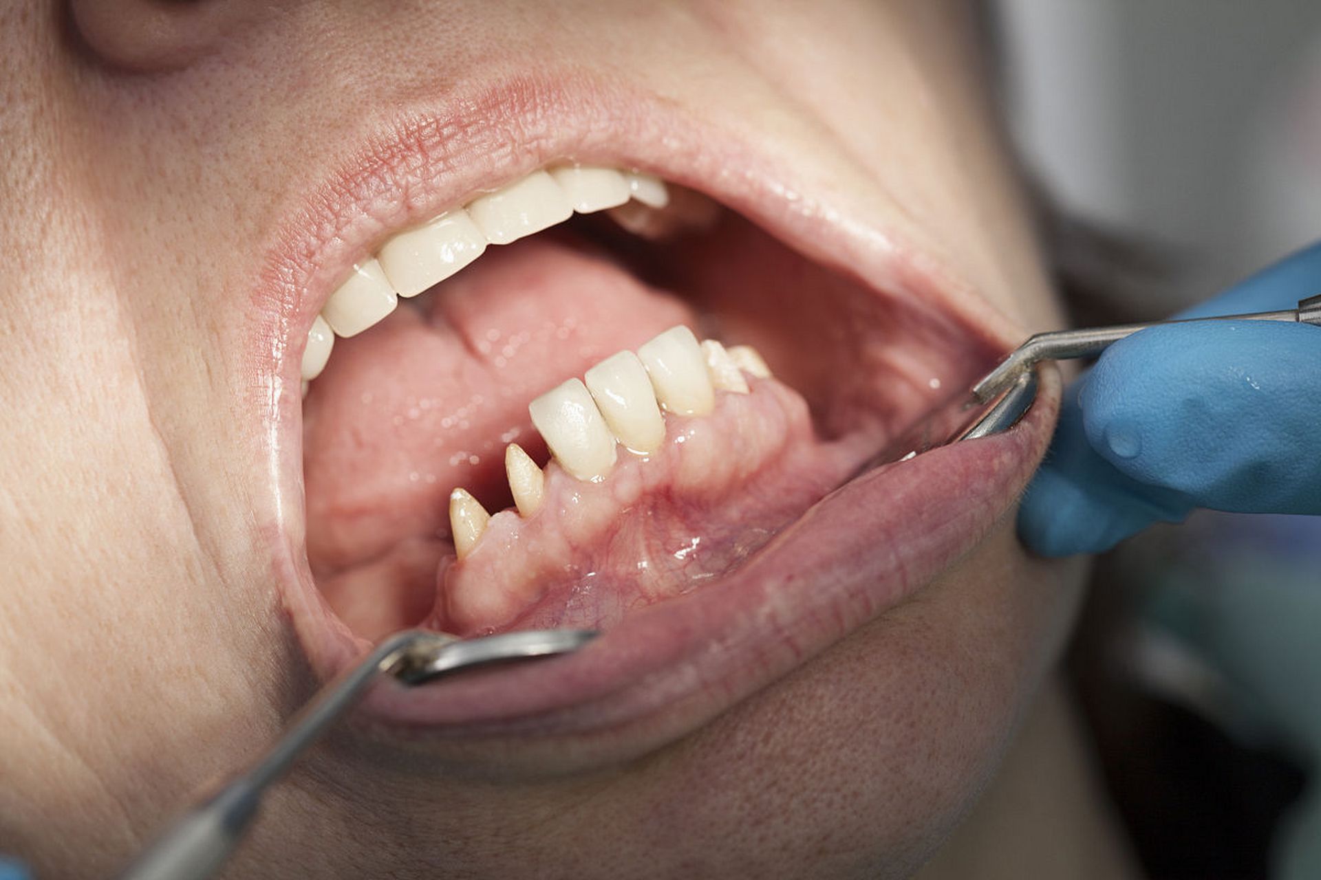 牙齿最末端的肉肿痛可能是由于多种原因引起的,这包括但不限于以下