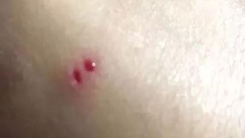 女子回家途中被竹叶青毒蛇咬中!当场拍下照片自救