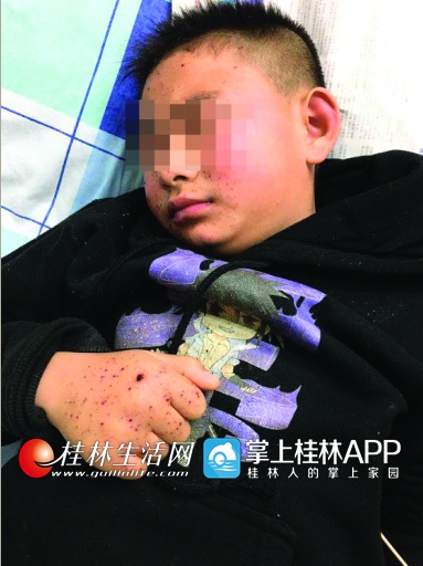 桂林三名熊孩子玩鞭炮被炸伤 其中一人可能会失明