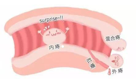 痔疮会自然好吗?