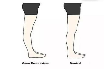 临床常见异常步态～膝过伸