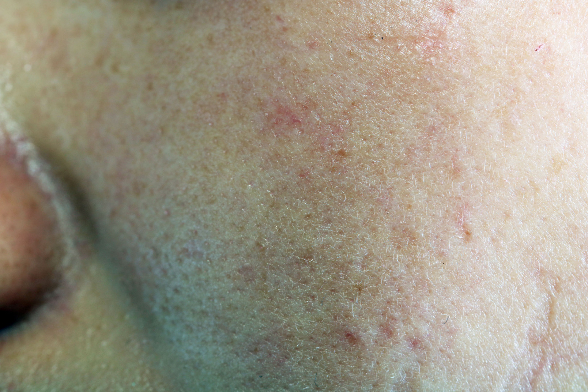 为什么脸上会长痘痘?