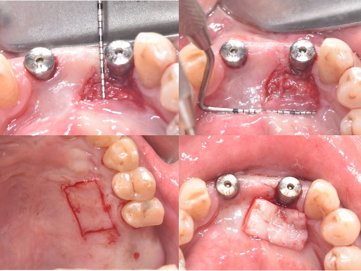 病例研究丨光动力治疗结合游离龈移植种植体周围炎