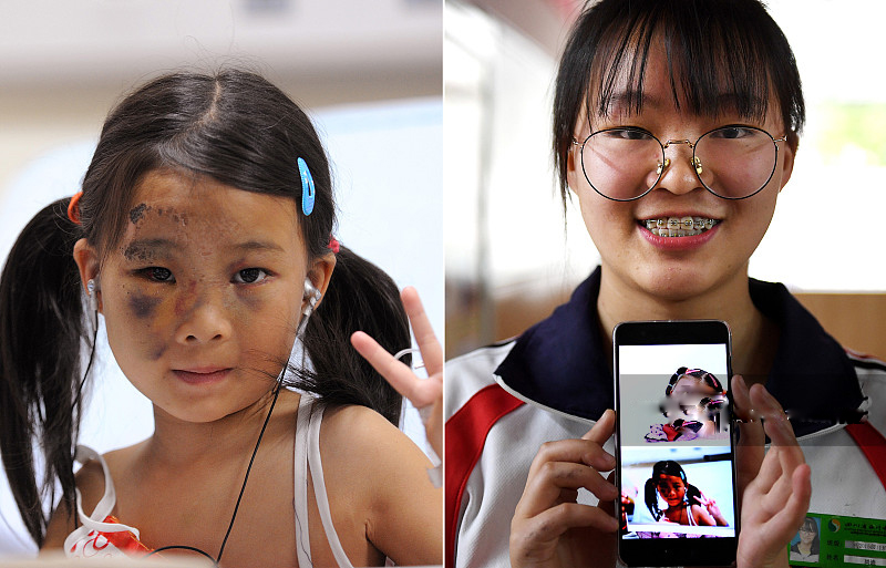 汶川地震十年:当年受伤的孩子现在长大了,一张照片让人心疼流泪