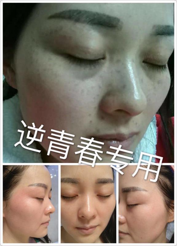 成都逆青春祛斑效果怎么样,看这里