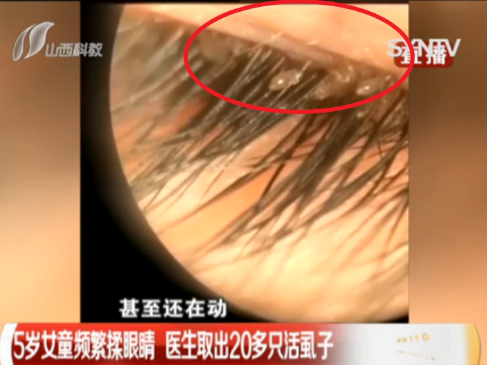 5岁女童眼里有20多只虱子,家长却只用了消炎药:以为只是结膜炎