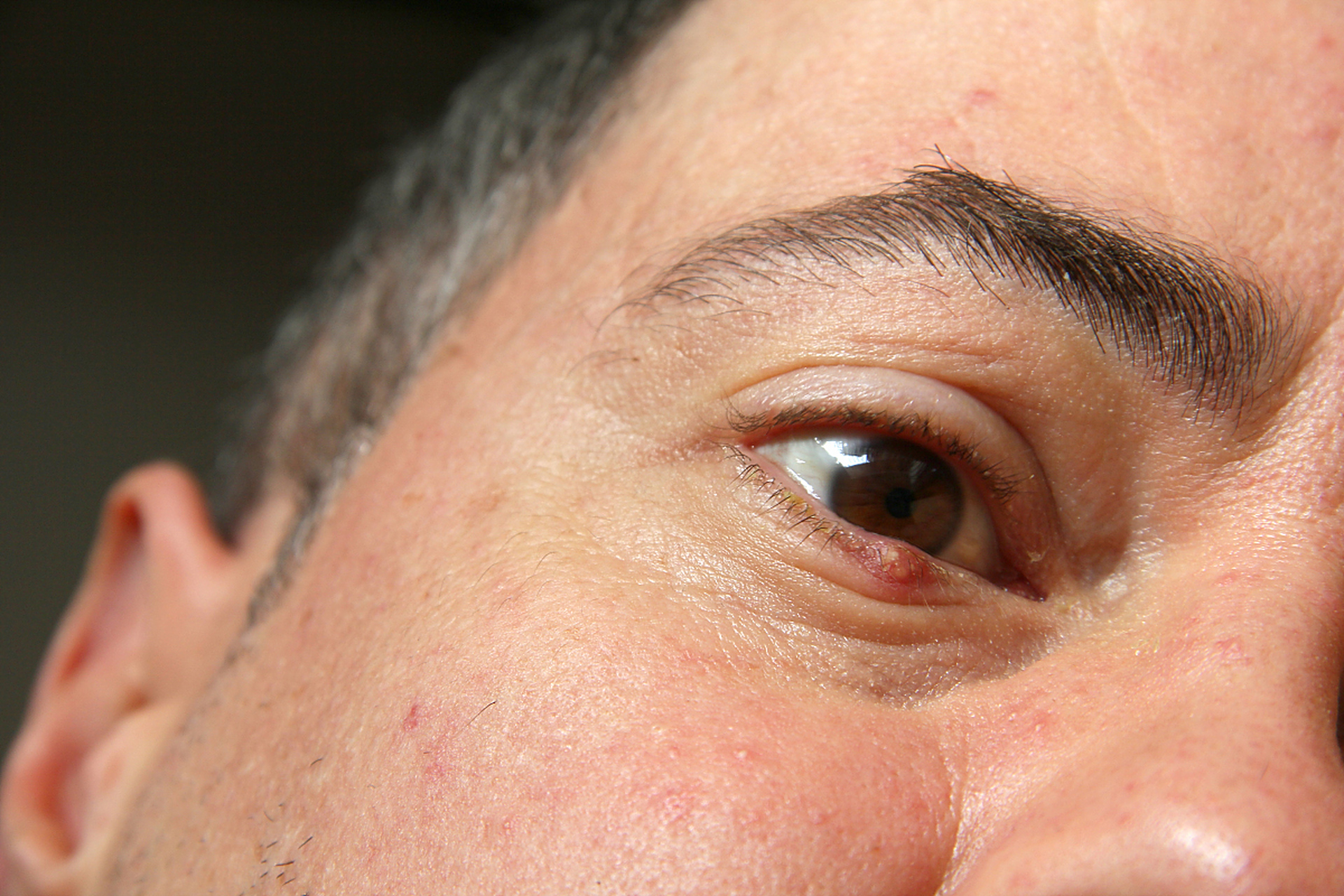 甲亢# #医路有你#  得了甲状腺功能亢进(甲亢)后,一些患者可能会出现