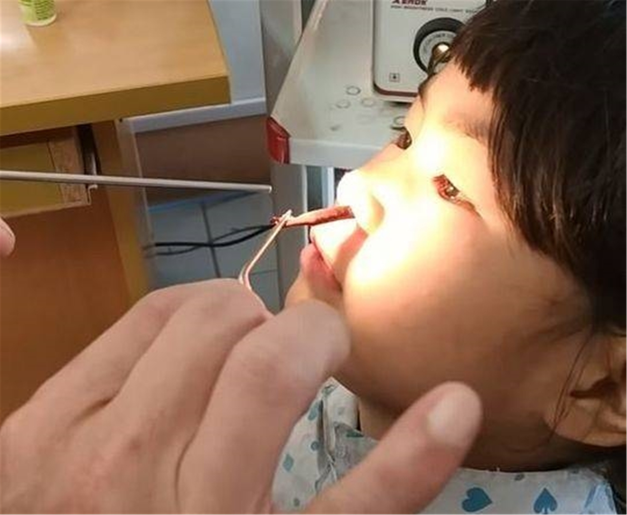 6岁女孩鼻子里取出活虫,医生称与饮水有关