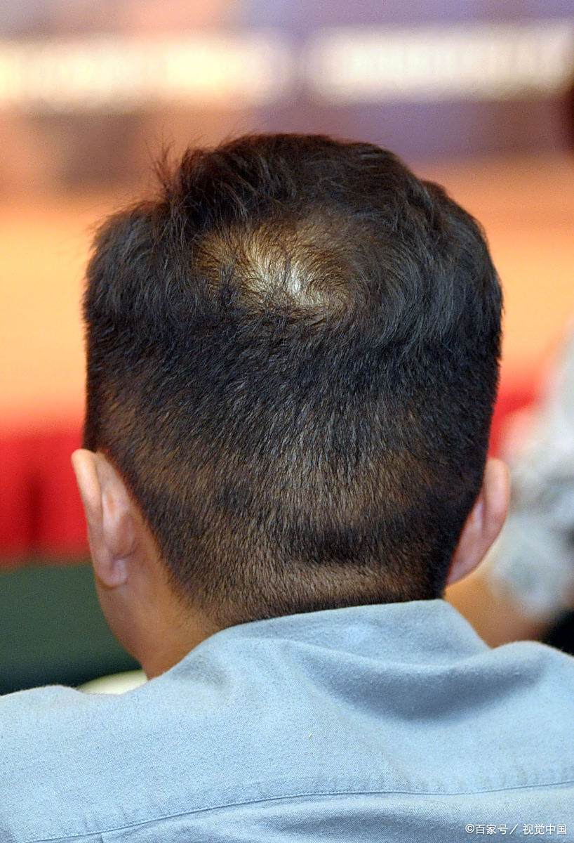 植发后,后脑勺的头发会变稀疏吗 #医美科普挑战赛