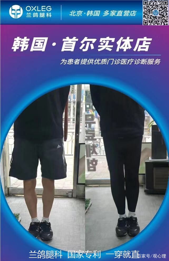 矫正o型腿
