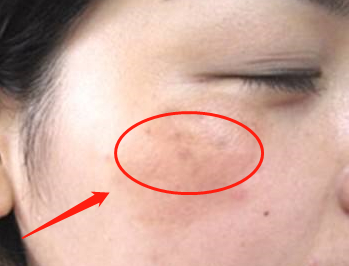 脸上如果有4个表现,可能要降血脂了