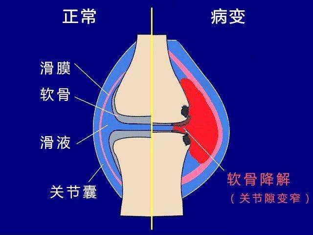 膝關節炎打玻璃酸鈉,真的很痛嗎?其實你誤解了