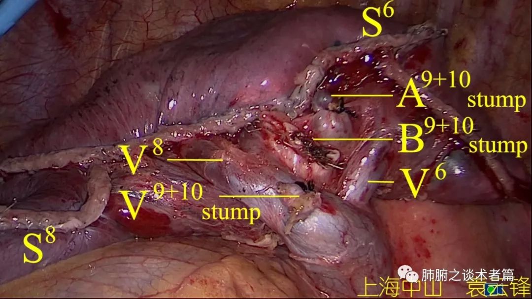 袁云锋教授:ls 9 10肺段切除详解