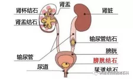 有泌尿系结石,这些事情你要知道