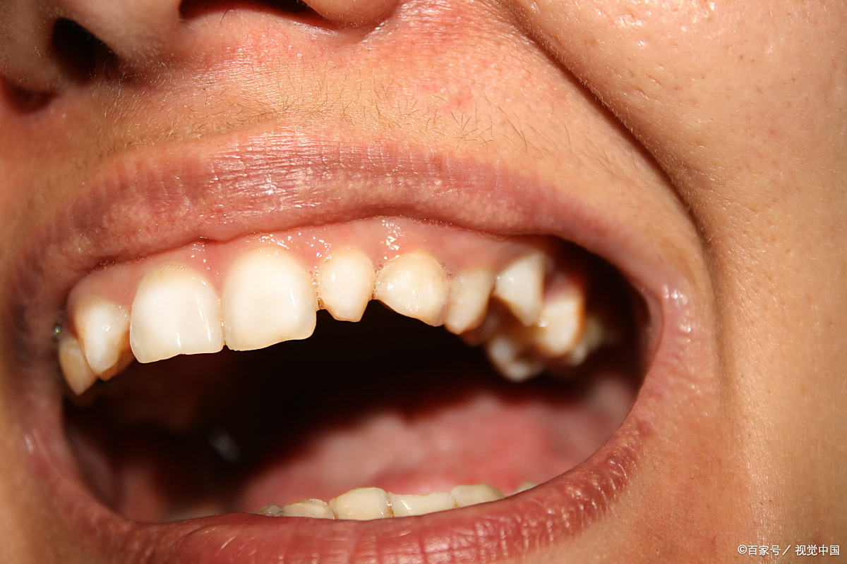 今天我们来聊聊一个大家都关心的话题:老年人牙齿松动怎么办?