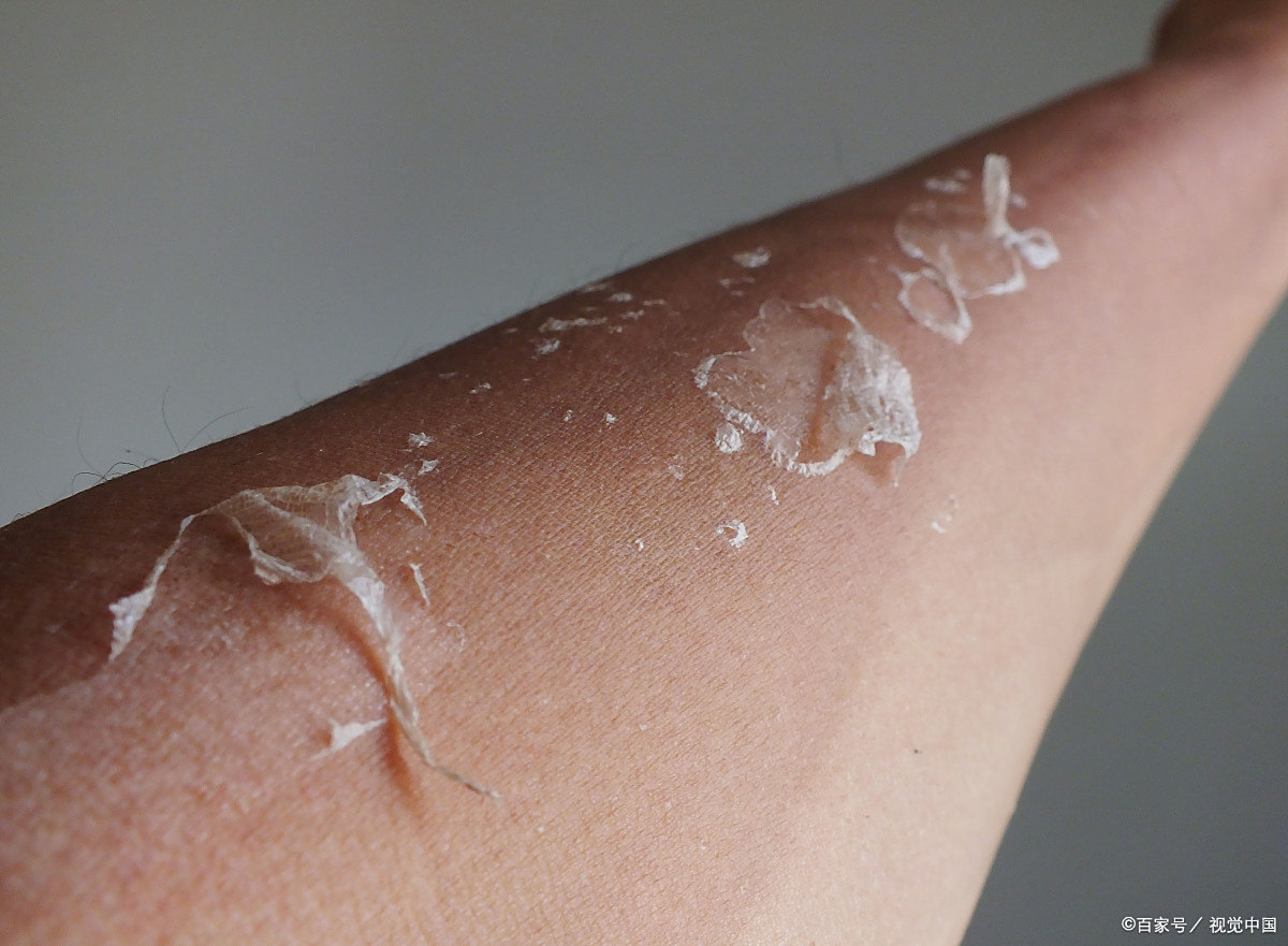 被晒伤了涂什么药管用