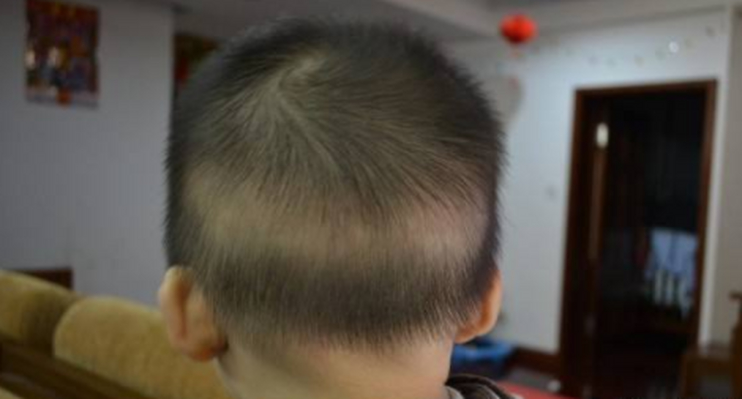 【孩子枕秃就是因为缺钙吗?