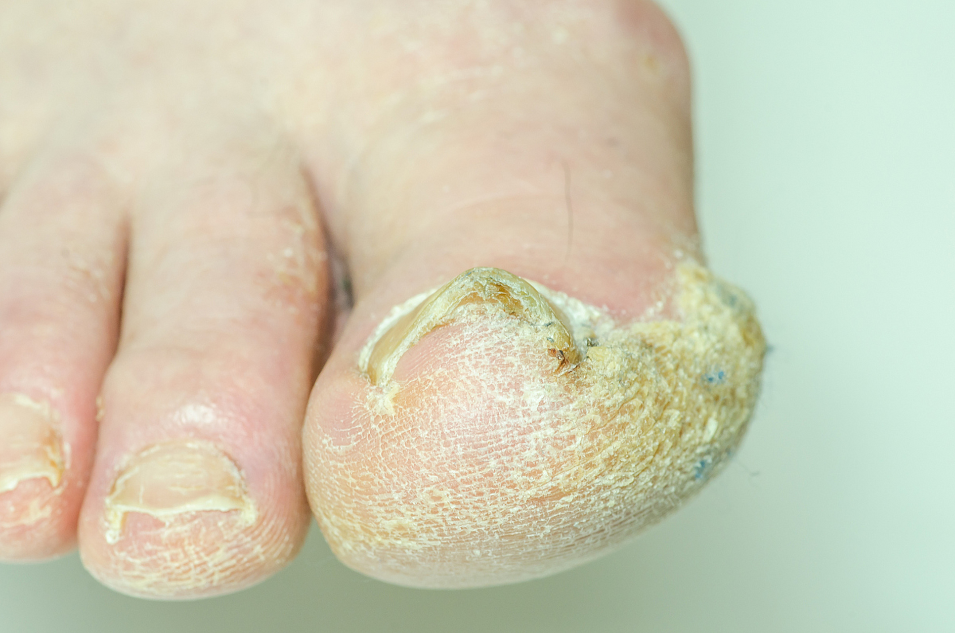 皲裂#   首先,让我们来了解一下手足皲裂的原因.