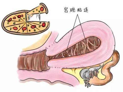 接好孕!宫腔粘连综合征与不孕关系