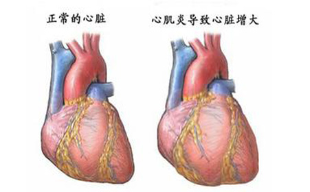 一场"感冒"后26岁女孩竟心脏骤停3次 "爆发性心肌炎"不容小觑