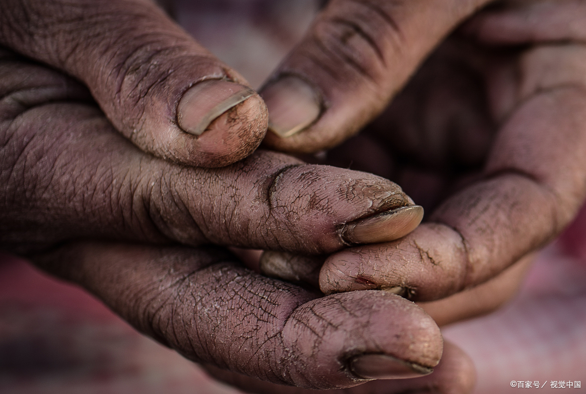 冬天手指开裂怎么办 分享五个小方法快速愈合