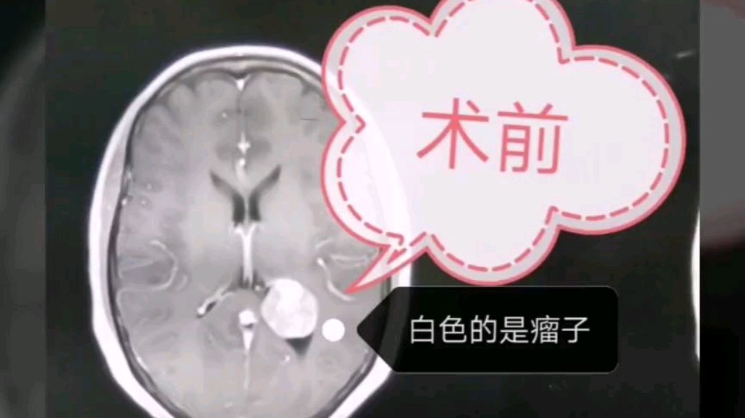 脑子里面长了鸡蛋大的肿瘤怎么办